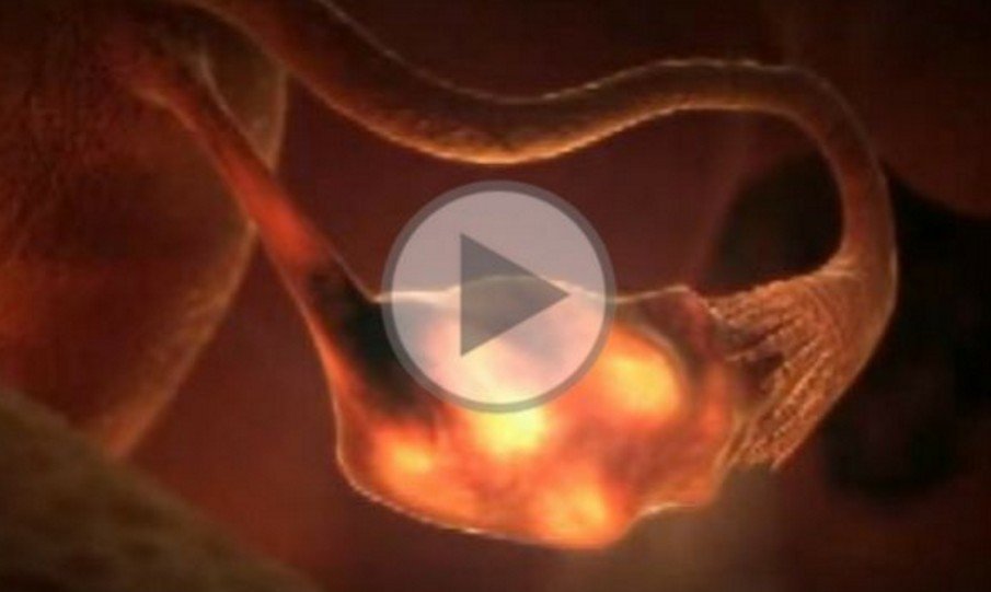 Πώς γίνεται η εξωσωματική γονιμοποίηση βήμα-βήμα (βίντεο)
